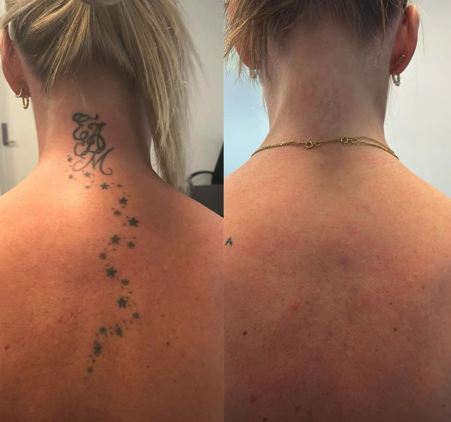 How to remove a permanent tattoo at home?