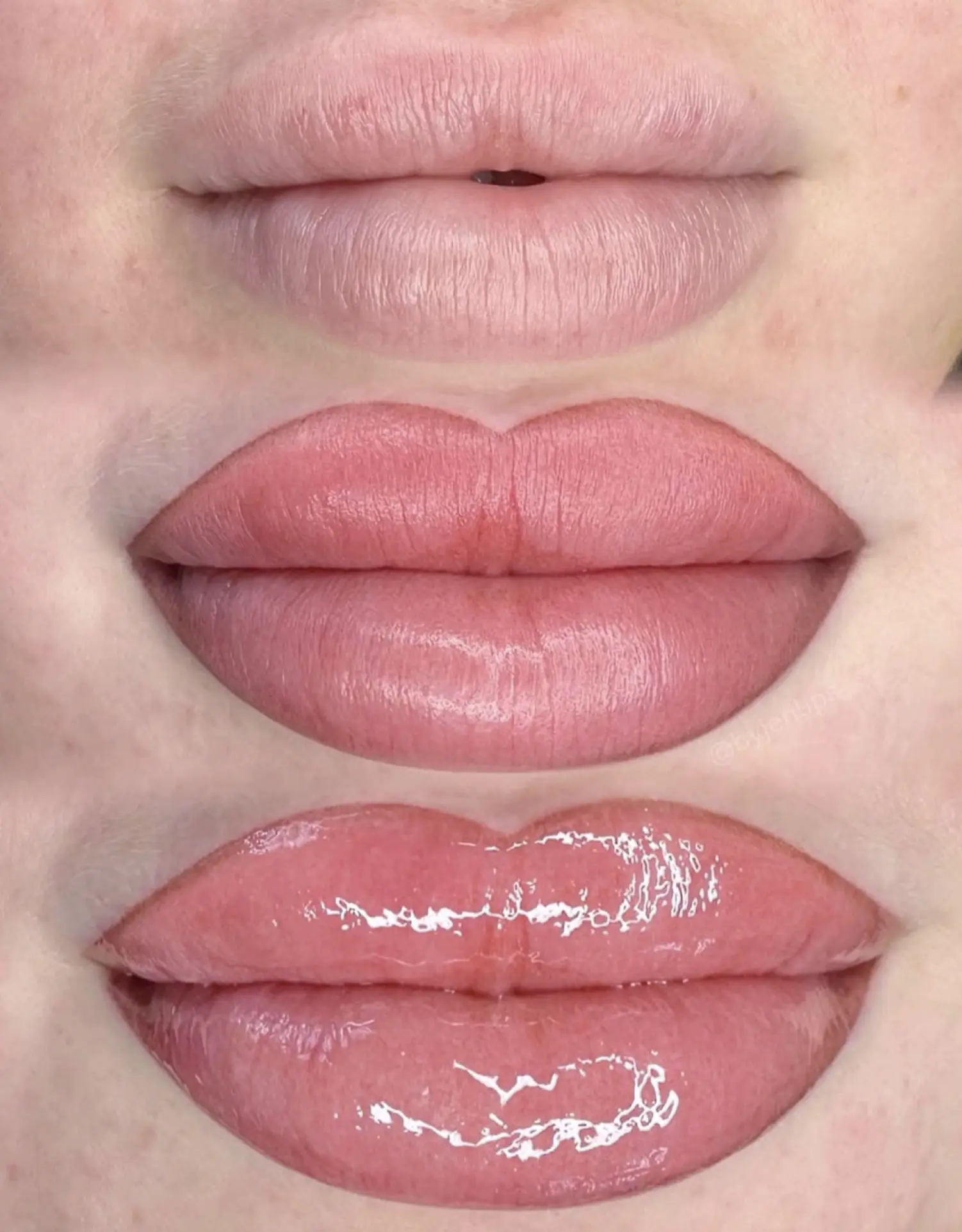 What’s the Downtime After Lip Neutralisation?